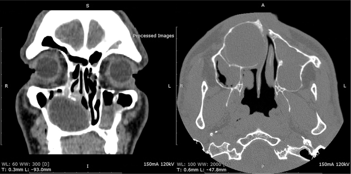 Aggressive abscesses in the head and neck region of probable odontogenic origin – two case reports