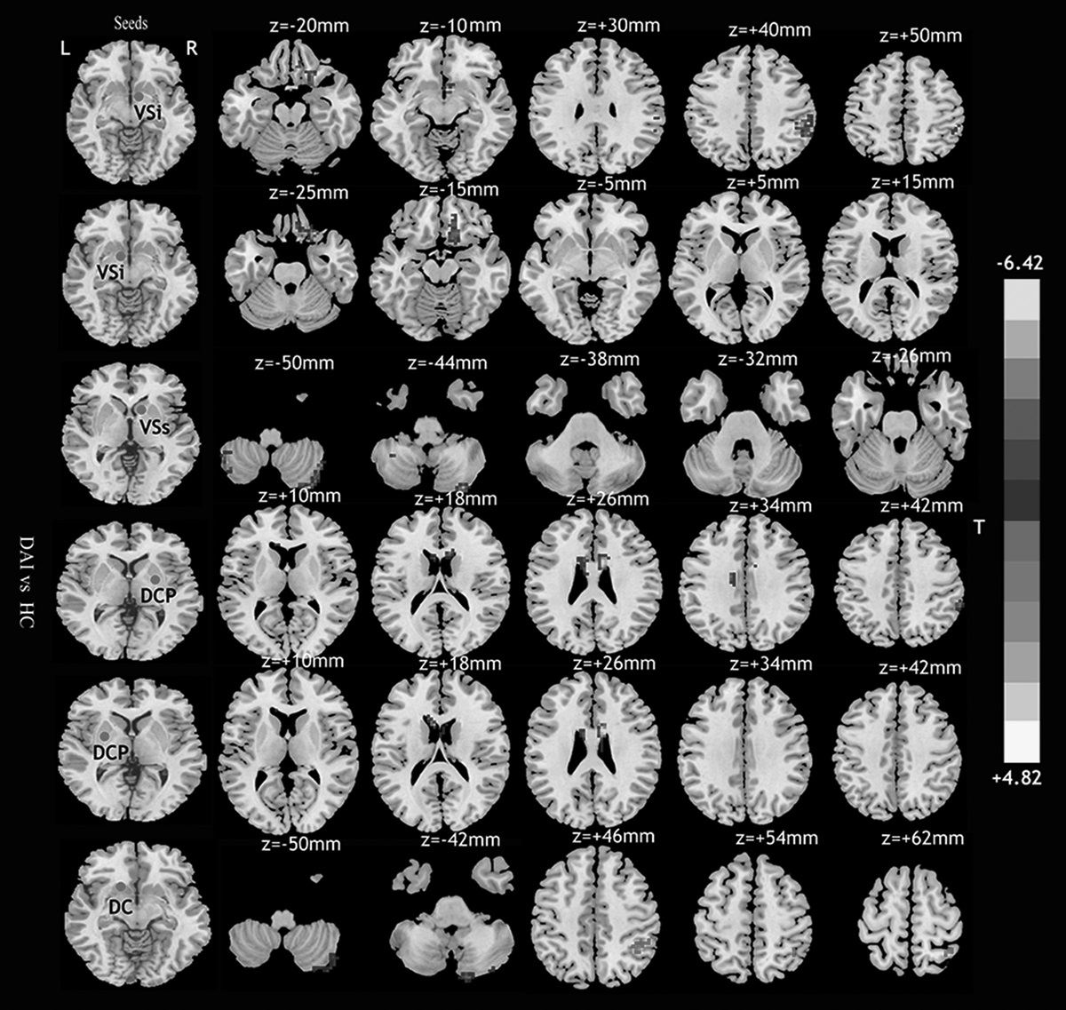 Disrupted functional connectivity of the striatum in patients with diffuse axonal injury: a resting-state functional MRI study