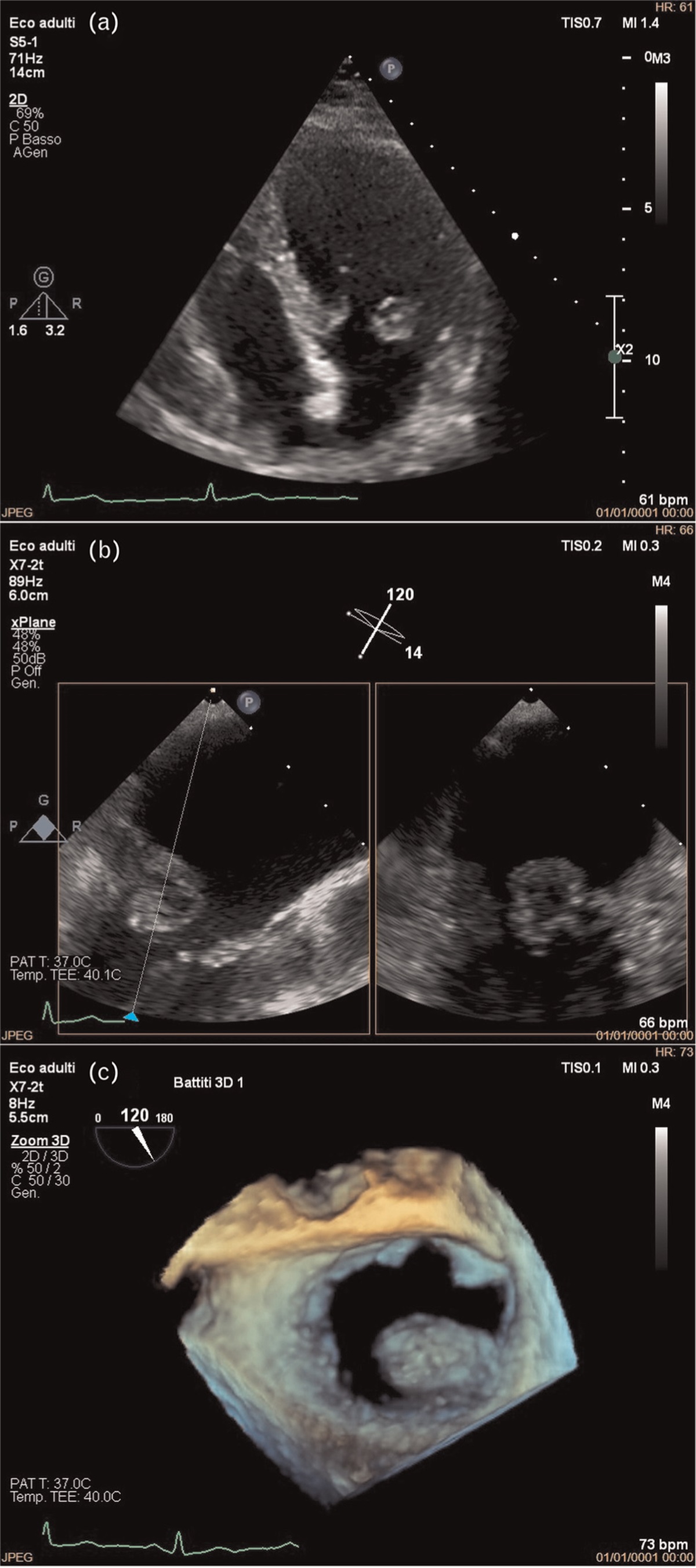 An incidental finding of a challenging mitral mass: cardiac surgery or not?