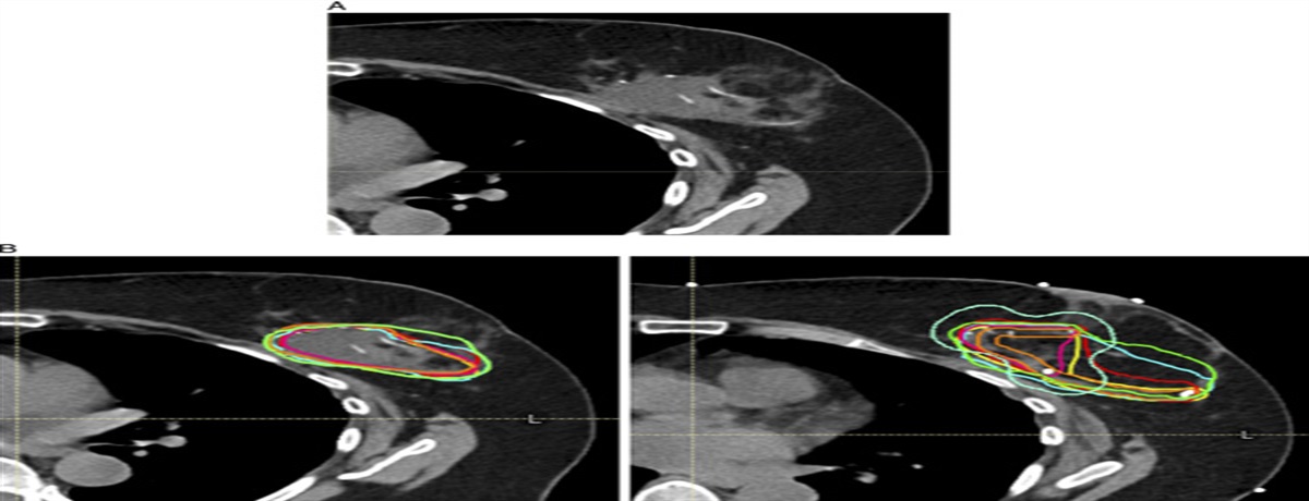 Comparison of Tumor Bed Delineation Using a Novel Radiopaque Filament Marker Versus Surgical Clips for Targeting Breast Cancer Radiotherapy