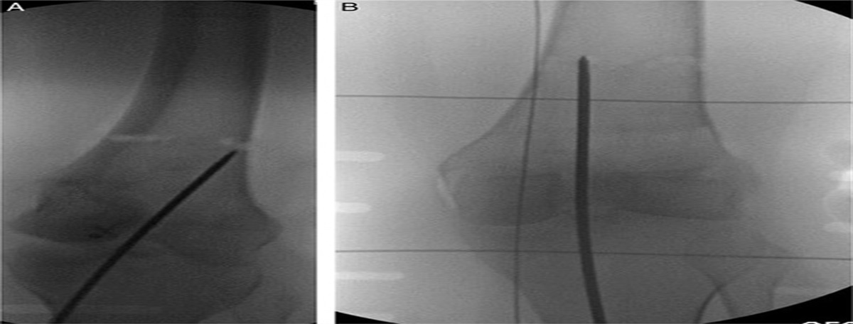 A Modified Reverse Planning Method for Correction of Distal Femoral Valgus Deformity: Surgical Technique and Early Results