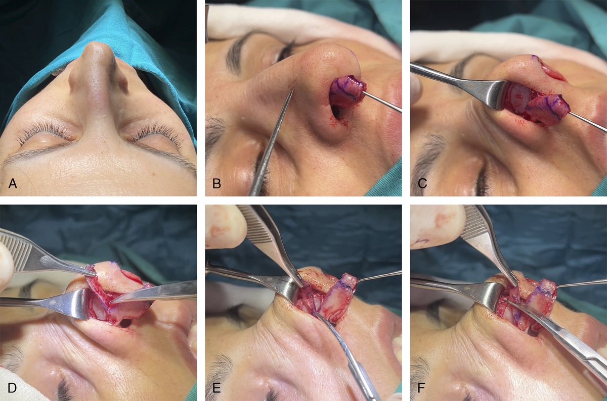 Lateral Crural Turn-Up Flap for Increasing the Volume of Cartilaginous Nasal Sidewall in Closed-Approach Dorsal Preservation Rhinoplasty