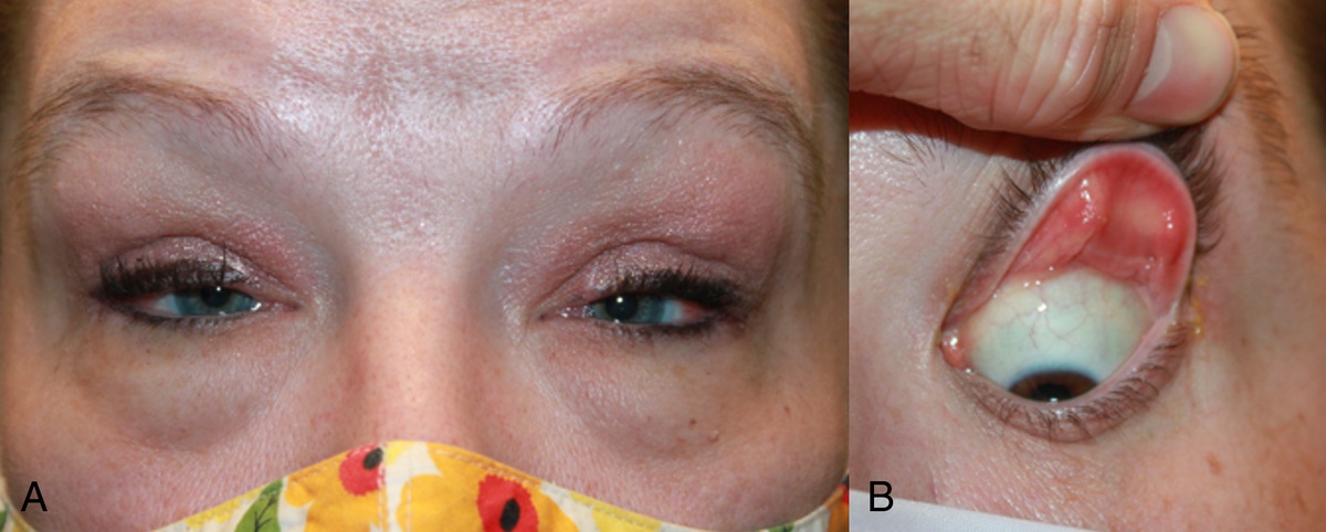 Severe Upper Lid Fornix Prolapse After a Ptosis Repair in Floppy Eyelid Syndrome: A Case Report