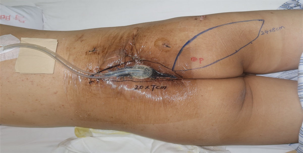 Successful Reconstruction of Complex Sacrococcygeal Defects Using Chimeric Perforator Propeller Flap