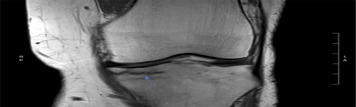 Subchondral Insufficiency Fractures of the Knee: A Clinical Narrative Review