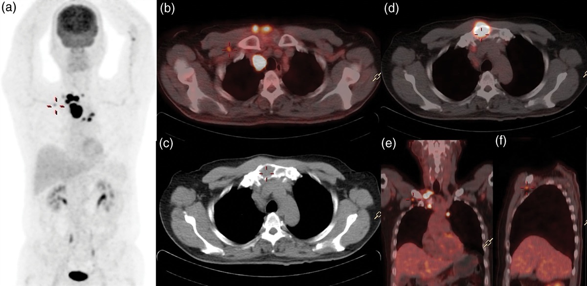 The role of 18F-FDG-PET/CT in the management of differentiated thyroid cancer