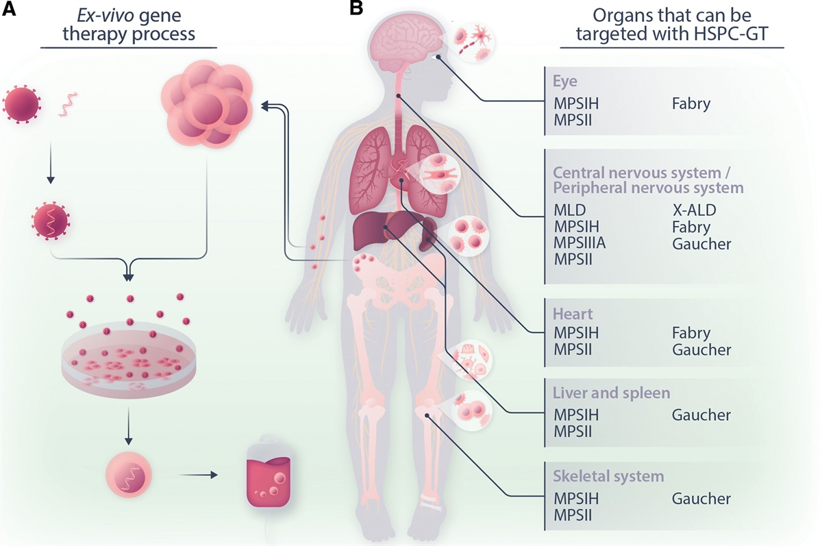 Current and Future Perspective in Hematopoietic Stem Progenitor Cell-gene Therapy for Inborn Errors of Metabolism