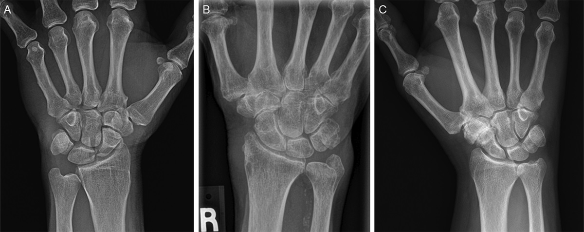 Management of Scaphotrapeziotrapezoid Osteoarthritis: A Critical Analysis Review