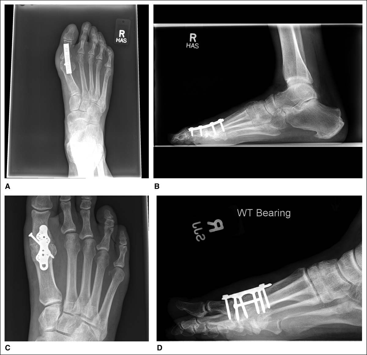 Analysis of the Costs and Complications of First Metatarsophalangeal Joint Arthrodesis Comparing Locked and Non-locked Plate Fixation Constructs