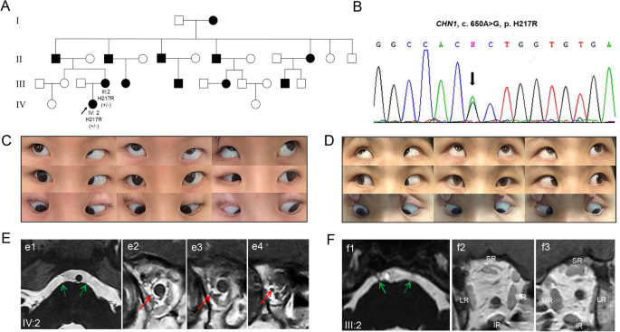 Two novel CHN1 variants identified in Duane retraction syndrome pedigrees disrupt development of ocular motor nerves in zebrafish