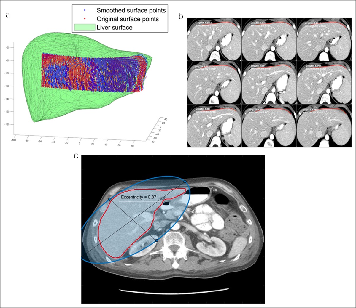 Using Artificial Intelligence to Predict Cirrhosis From Computed Tomography Scans