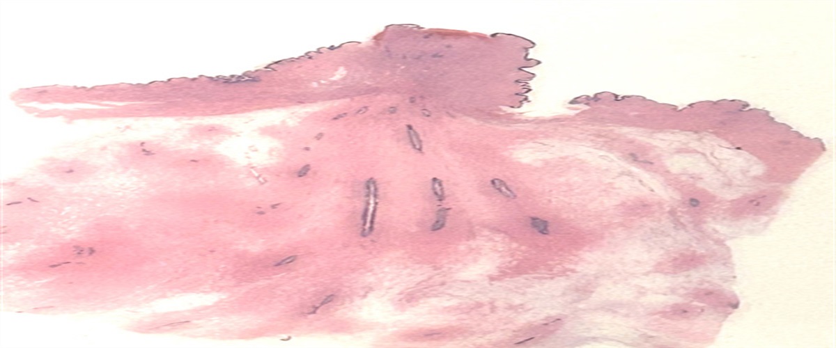 Nipple Lesions of the Breast: An Update on Morphologic Features, Immunohistochemical Findings and Differential Diagnosis