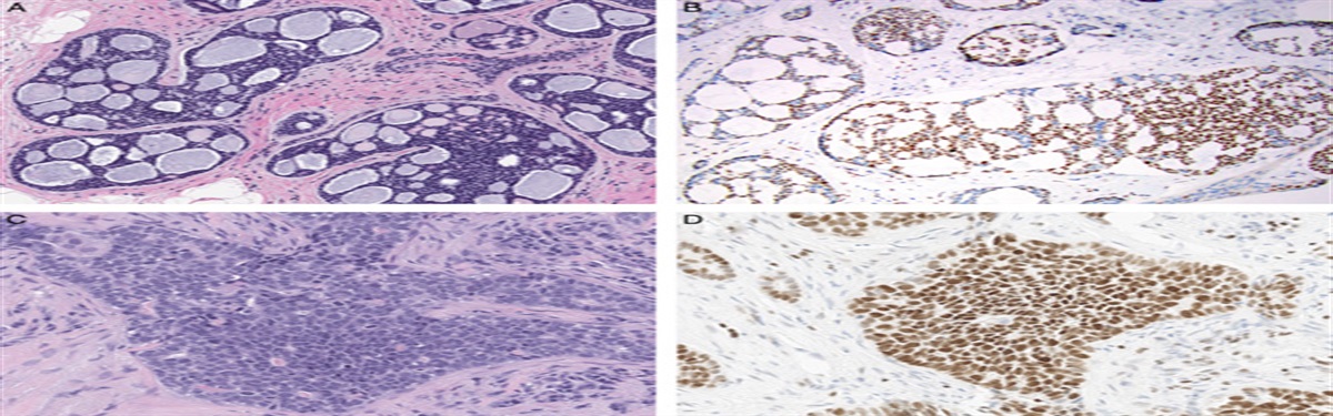 The Role of Novel Immunohistochemical Markers for Special Types of Breast Carcinoma