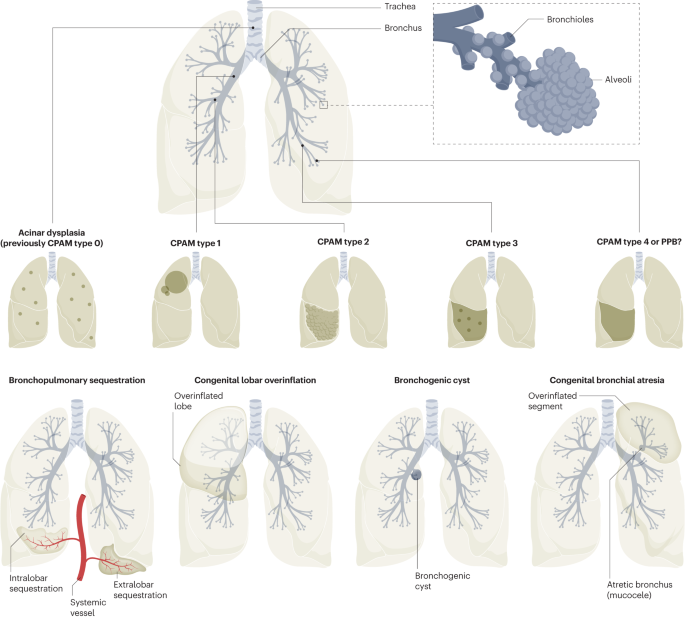 Congenital lung malformations