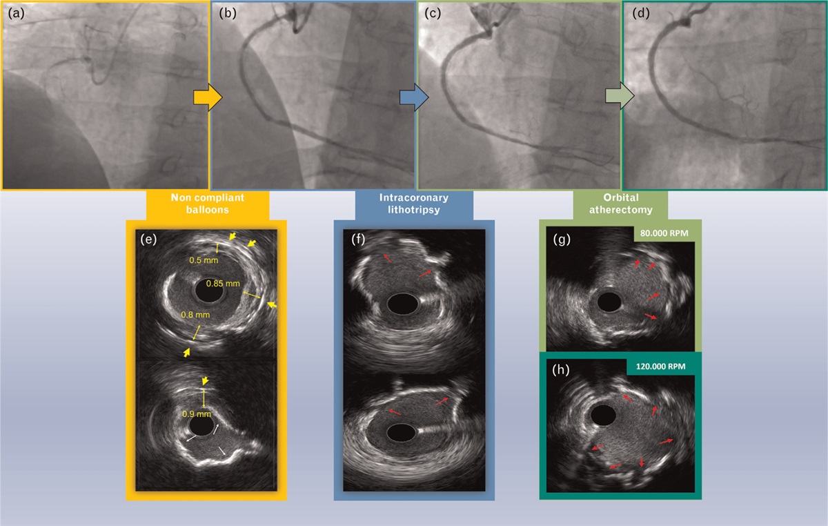 Intravascular ultrasound-guided ‘OrbiTripsy’ for a severely calcified neo-atherosclerotic coronary in-stent restenosis