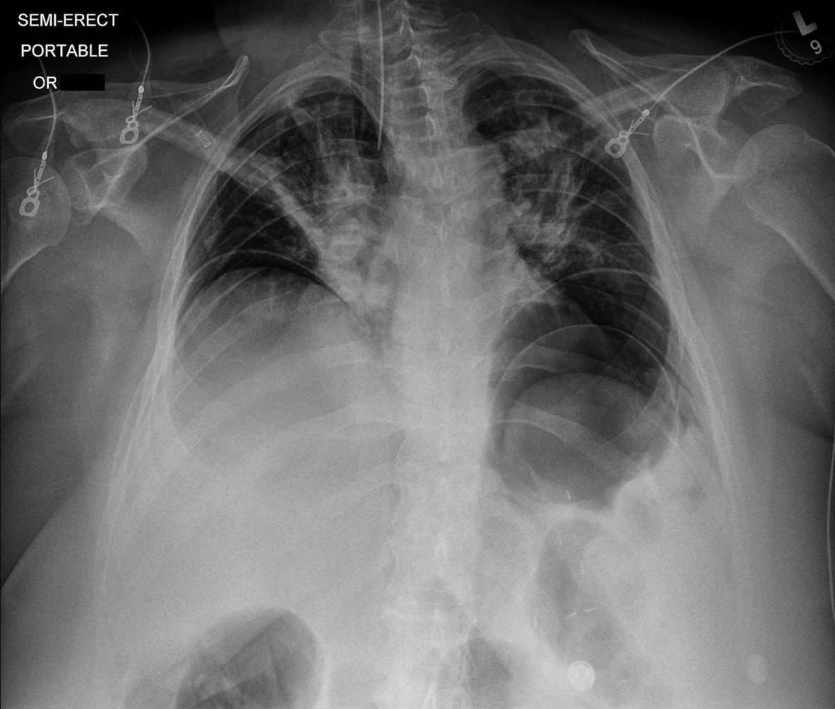Acute Respiratory Failure Complicating Endoscopic Sleeve Gastroplasty: A Case Report
