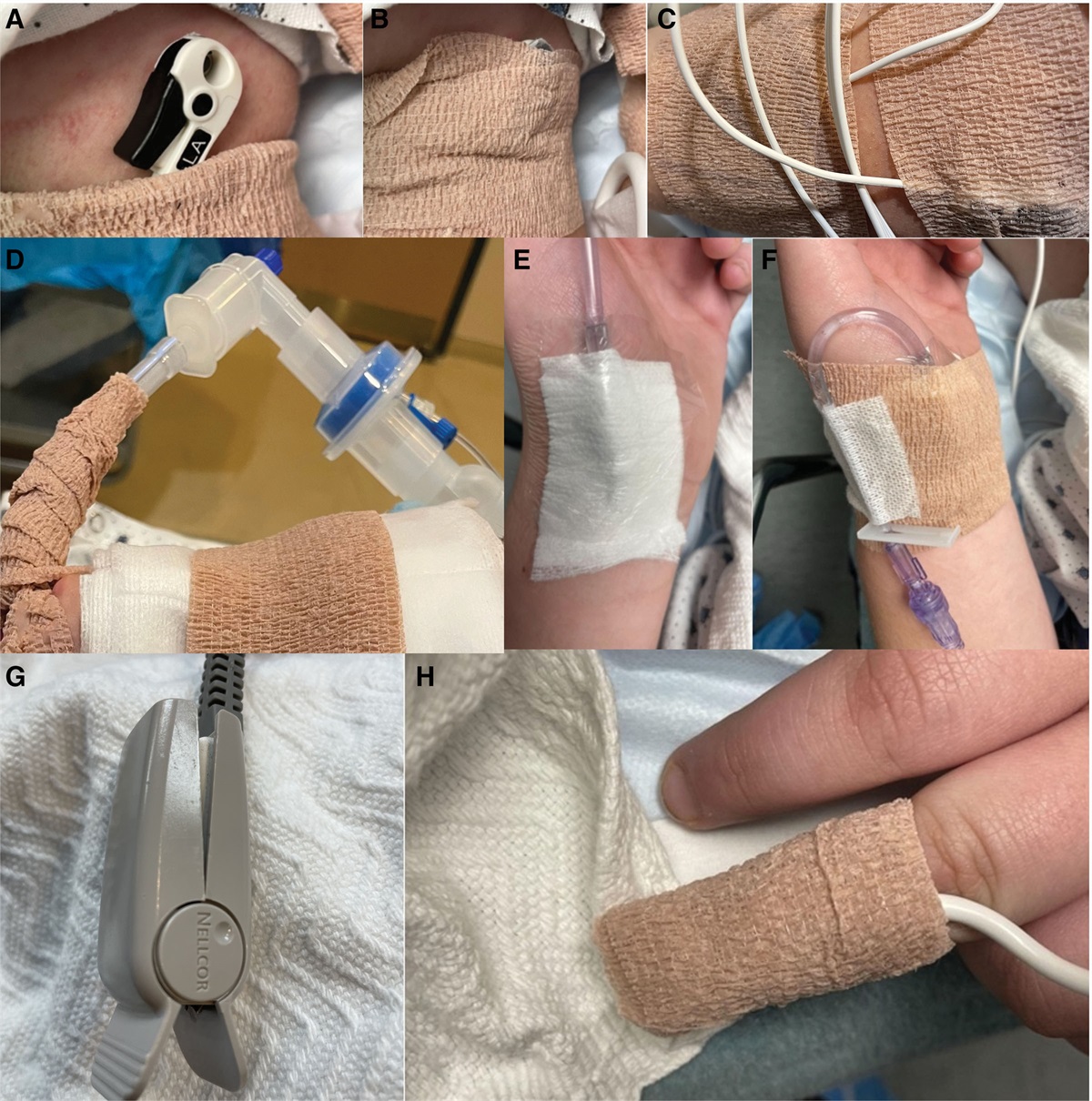 Utilizing Cohesive Bandage to Prevent Adverse Effects of Bleomycin Sclerotherapy: A Case Report