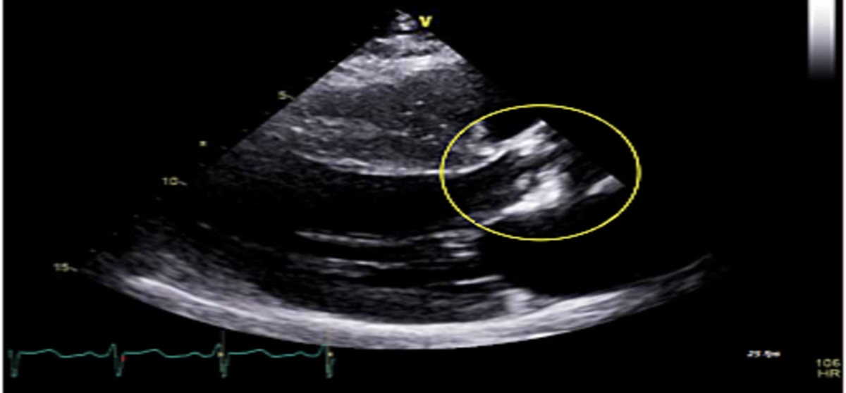 Heartbreak From Puppy Love: A Case of Pasteurella multocida Endocarditis and Review of the Literature