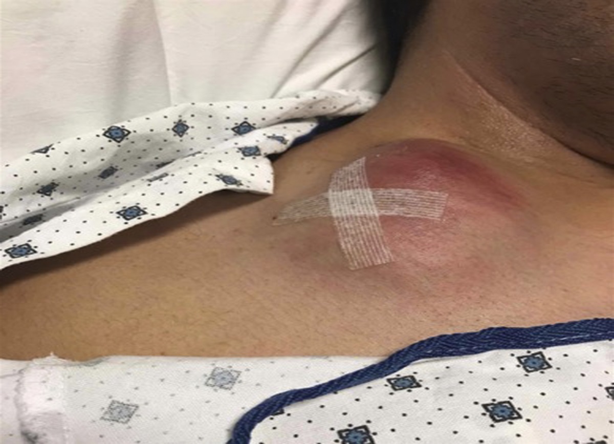Large Unidentified Neck Mass in an Immunocompetent Patient