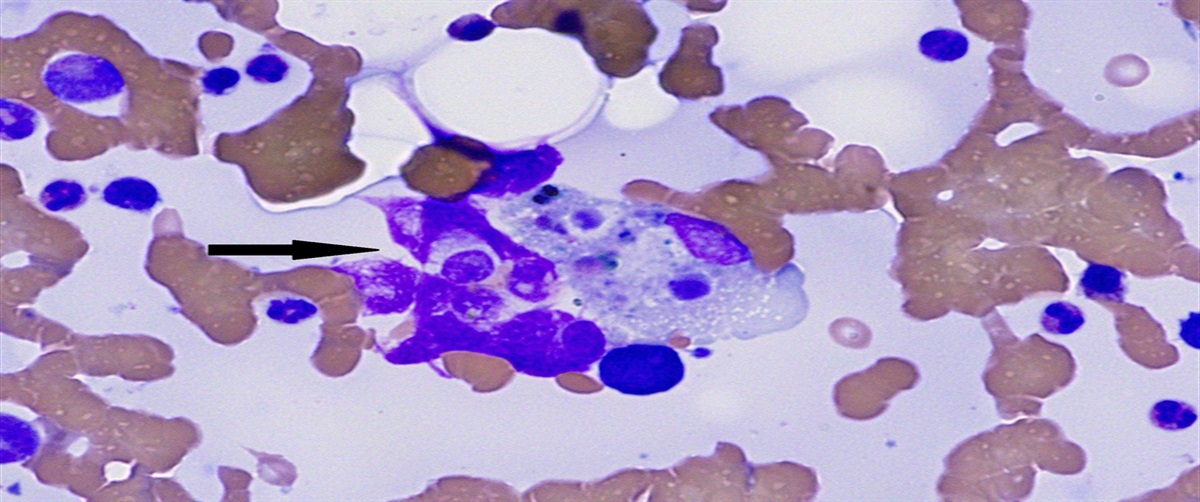 Rapid Diagnosis of Bartonella-Induced Hemophagocytic Lymphohistiocytosis Using Next-Generation Sequencing of Plasma