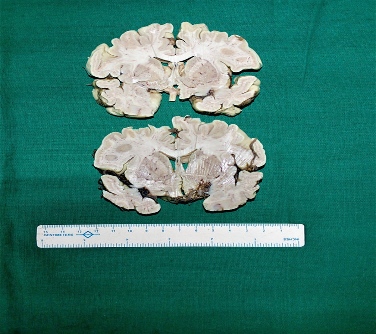 Incidental Subventricular Ependymal Cell Rests: A Rare Case Report