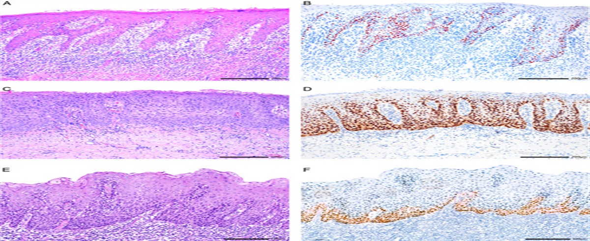 The Spectrum of HPV-independent Penile Intraepithelial Neoplasia: A Proposal for Subclassification