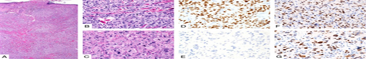 PRAME Expression Is a Useful Tool in the Diagnosis of Primary and Metastatic Dedifferentiated and Undifferentiated Melanoma