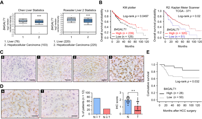 Decreased B4GALT1 promotes hepatocellular carcinoma cell invasiveness by regulating the laminin-integrin pathway