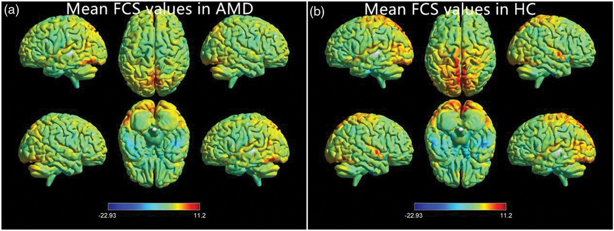 Abnormal functional connectivity strength in age-related macular degeneration patients: a fMRI study
