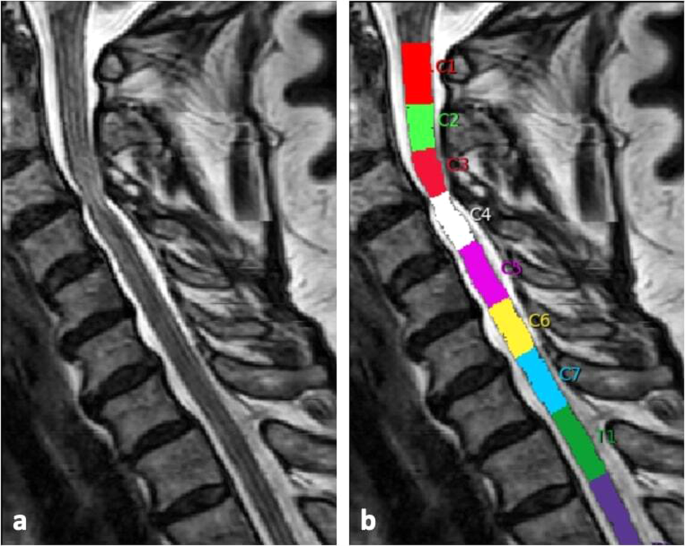 Application of the T1w/T2w mapping technique for spinal cord assessment in patients with degenerative cervical myelopathy