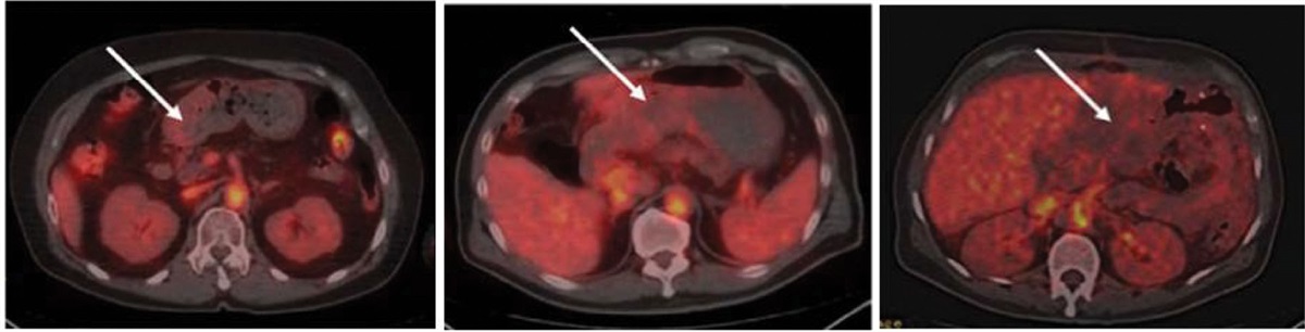 Pilot study of HER2 targeted 64Cu-DOTA-tagged PET imaging in gastric cancer patients