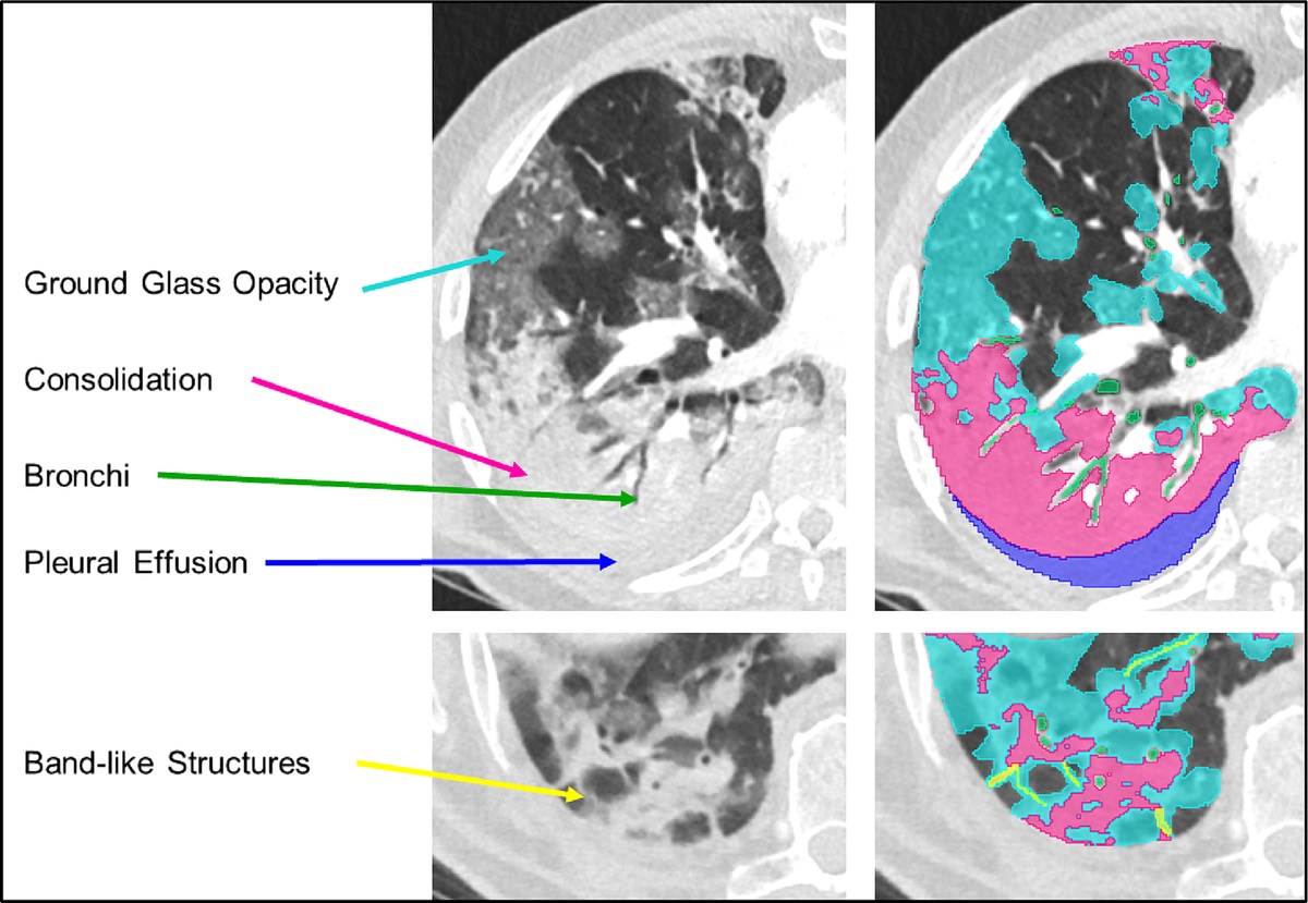 A Multiclass Radiomics Method–Based WHO Severity Scale for Improving COVID-19 Patient Assessment and Disease Characterization From CT Scans