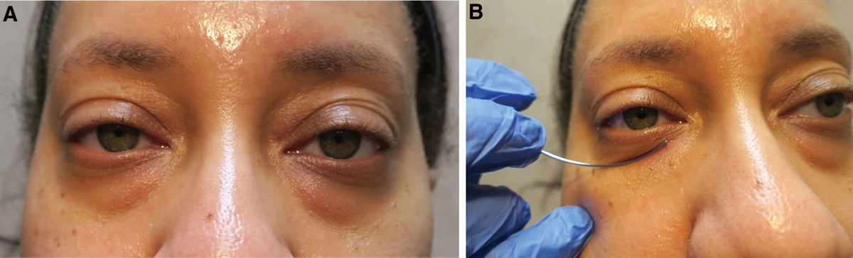 Eyelid Circles: Fat Excision Versus Repositioning