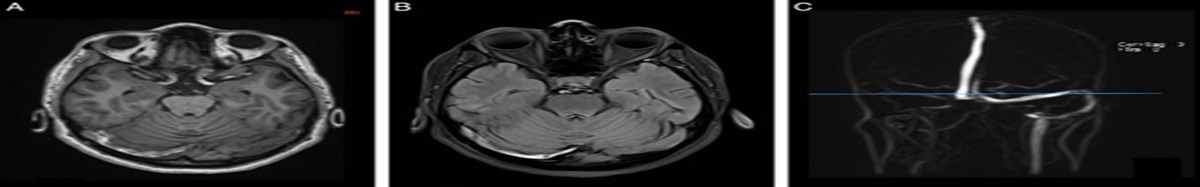 The Neuropsychiatric Side of Cerebral Venous Thrombosis: A Case of Delirium and Catatonia