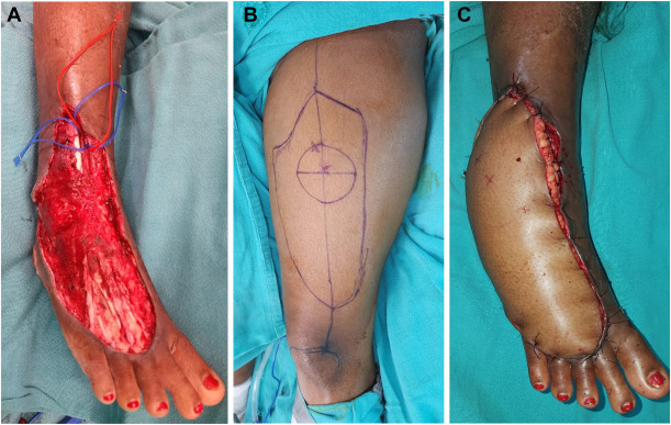 A Case of Cobra Bite in a Term Pregnant Woman: The Obstetric and Wound Management Challenges