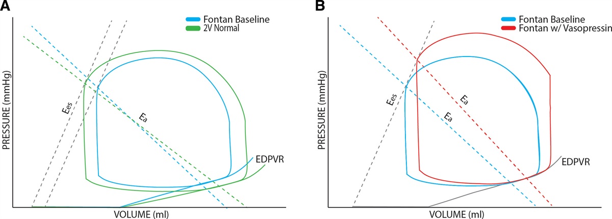 The Fontan Circulation Holds Water: The Impact of Arginine Vasopressin on the Fontan Circulation*