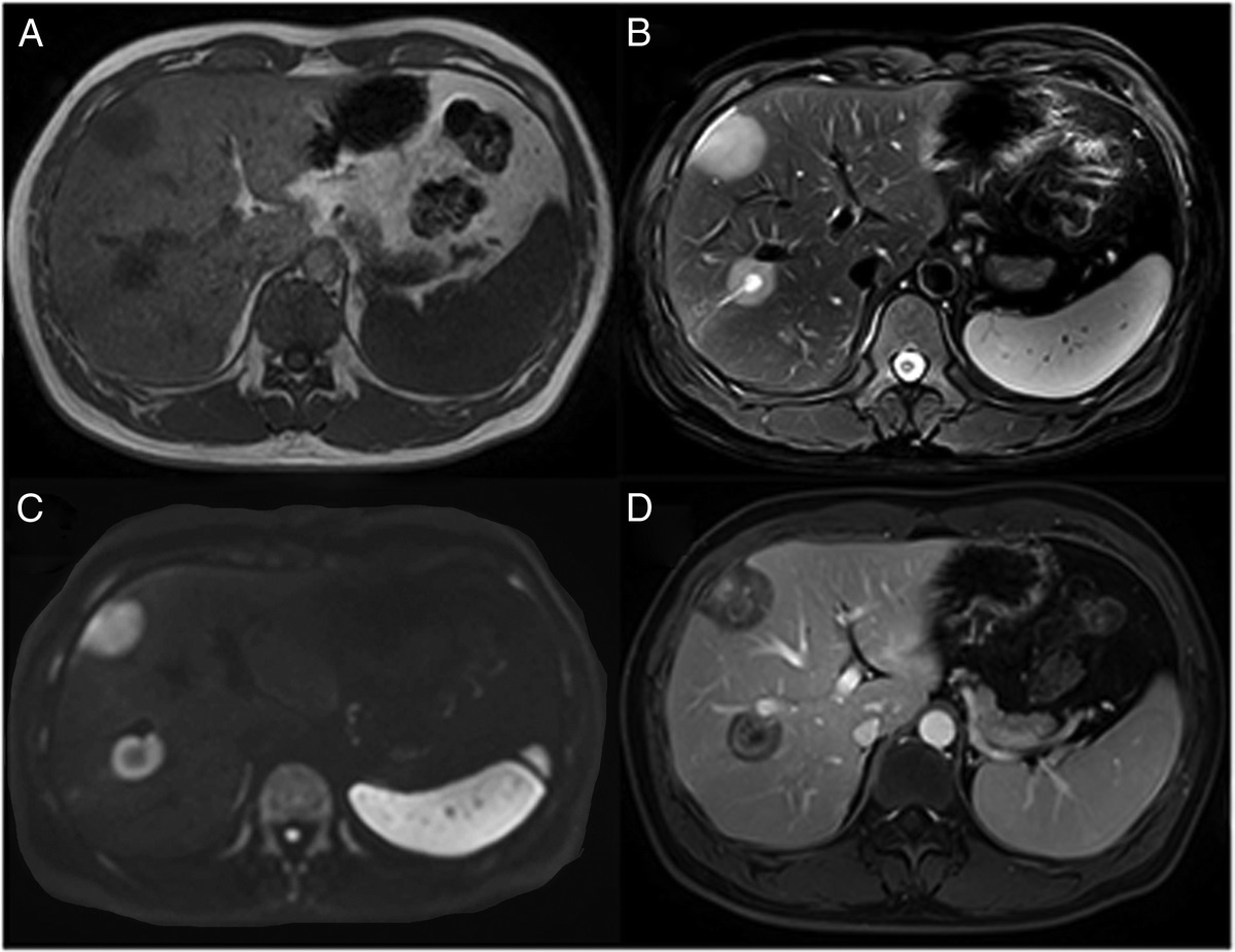 Multiple Intrahepatic Inflammatory Myofibroblastic Tumor on 68Ga-FAPI and 18F-FDG PET/CT