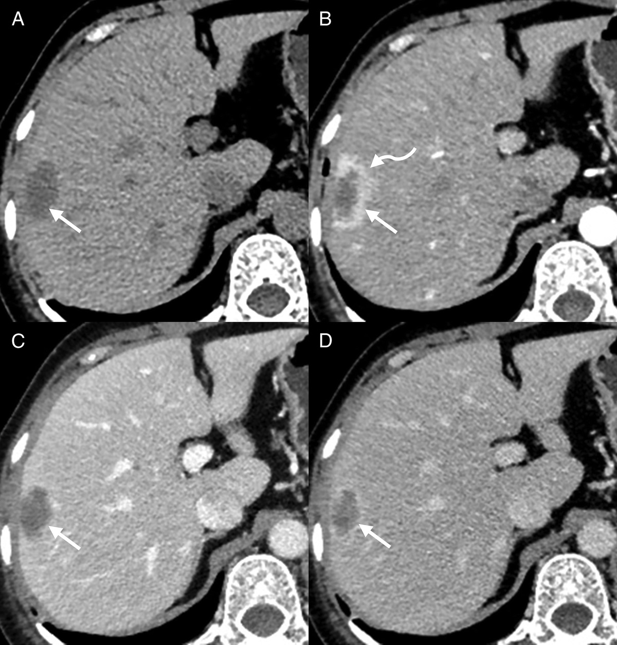68Ga-FAPI-04 Detected Hepatic Arteriovenous Malformation in a Patient With IgA Nephropathy