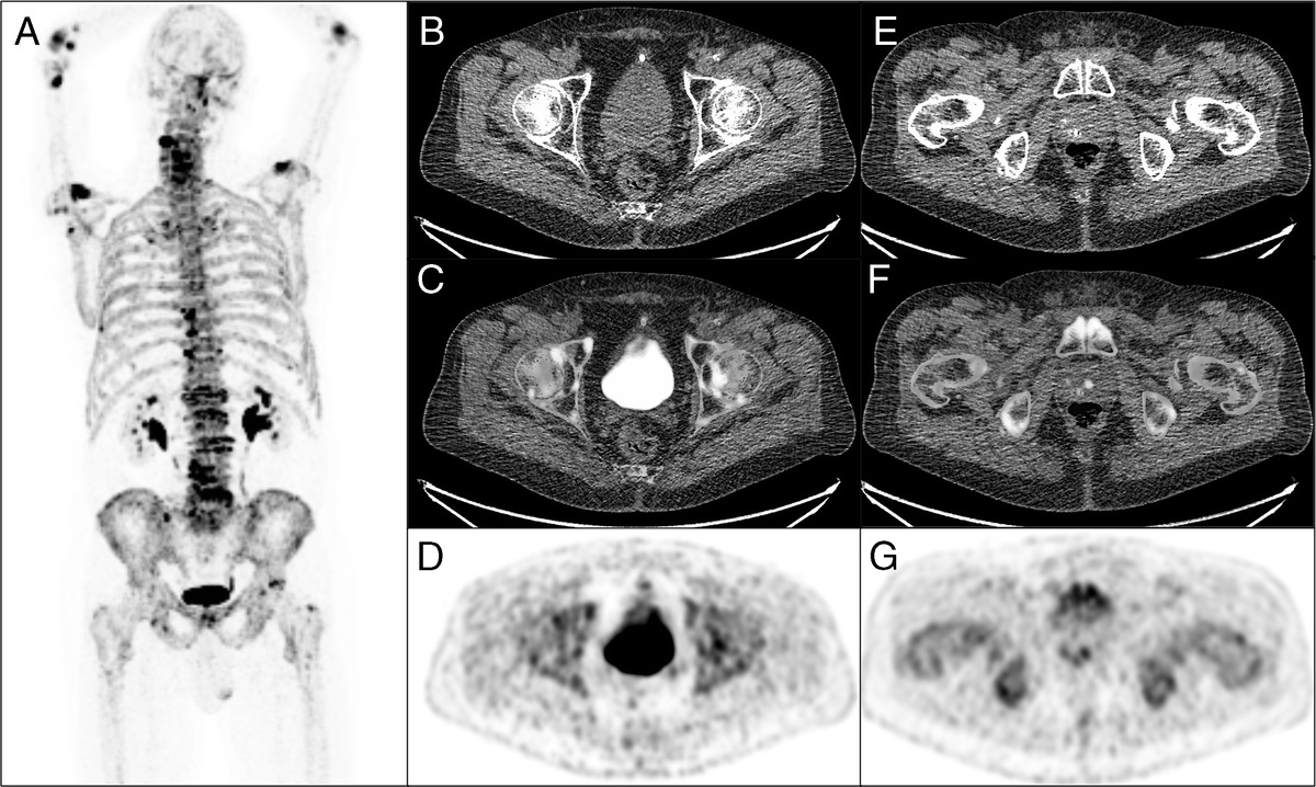 Simultaneous Uptake of 18F-NaF and 18F-FDG by Bladder and Prostate Calculi