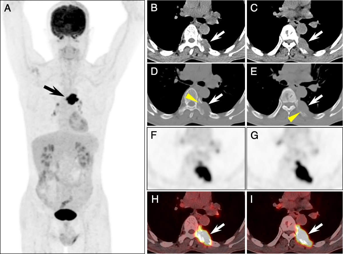 FDG PET/CT in a Case of Thoracic SMARCA4-Deficient Undifferentiated Tumor
