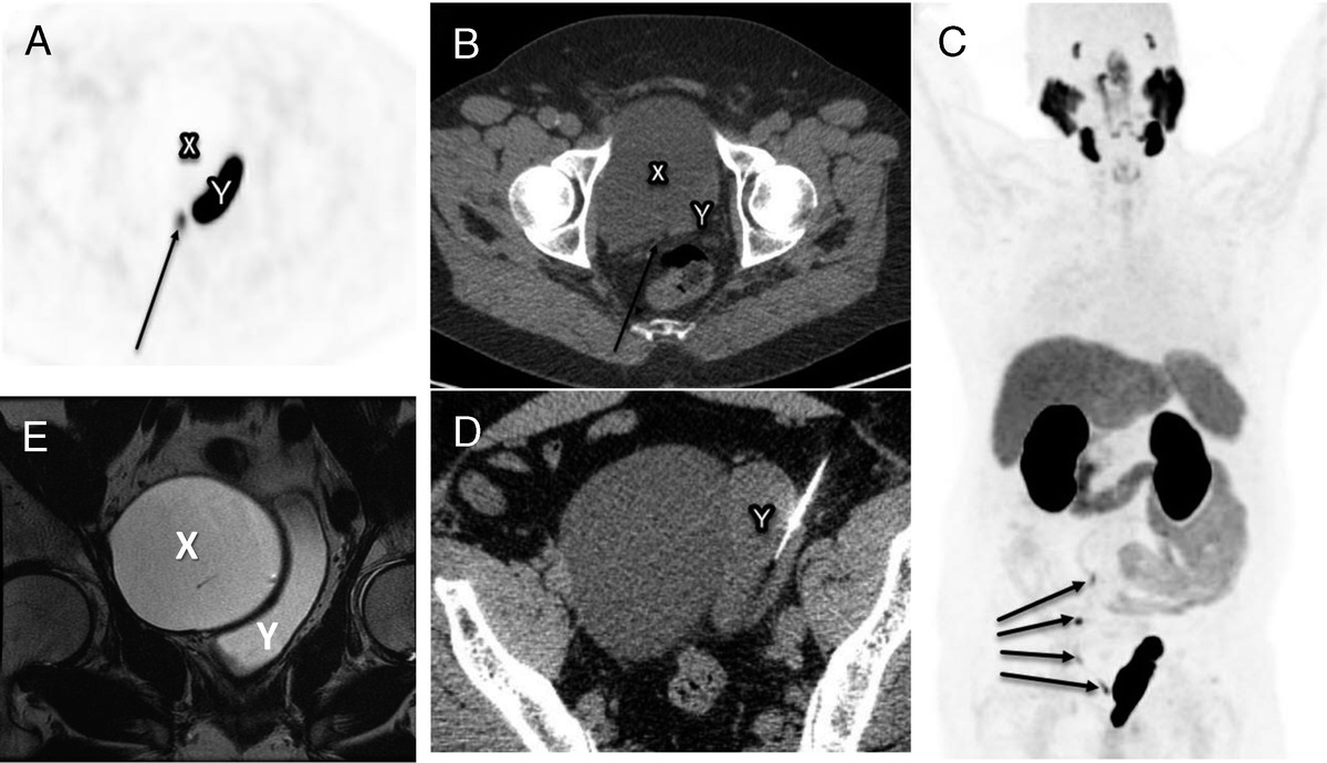Pitfall of 18F-PSMA PyL PET/CT Imaging of a Displaced Urinary Bladder as Recurrent Prostate Malignancy