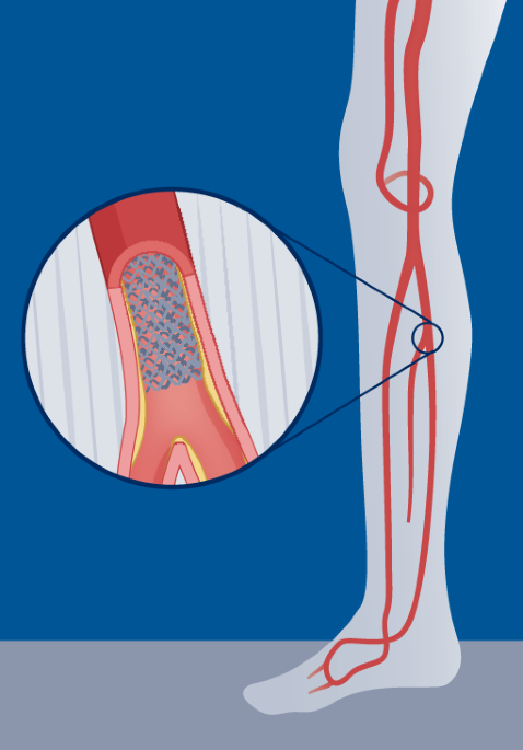 Drug-eluting resorbable scaffolds are superior to angioplasty for infrapopliteal artery disease