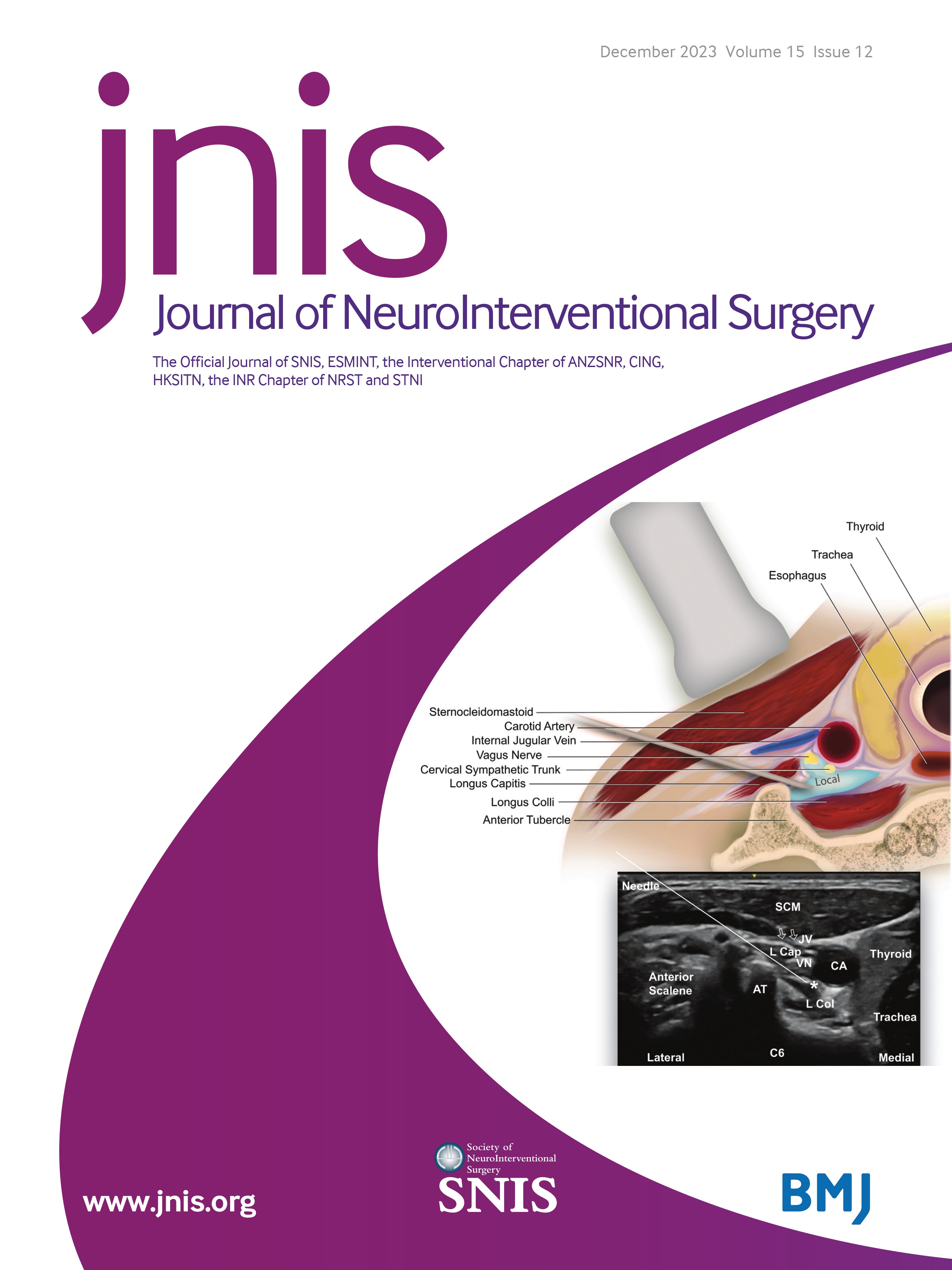 Safety and effectiveness of the Woven EndoBridge (WEB) system for the treatment of wide necked bifurcation aneurysms: final 5 year results of the pivotal WEB Intra-saccular Therapy study (WEB-IT)