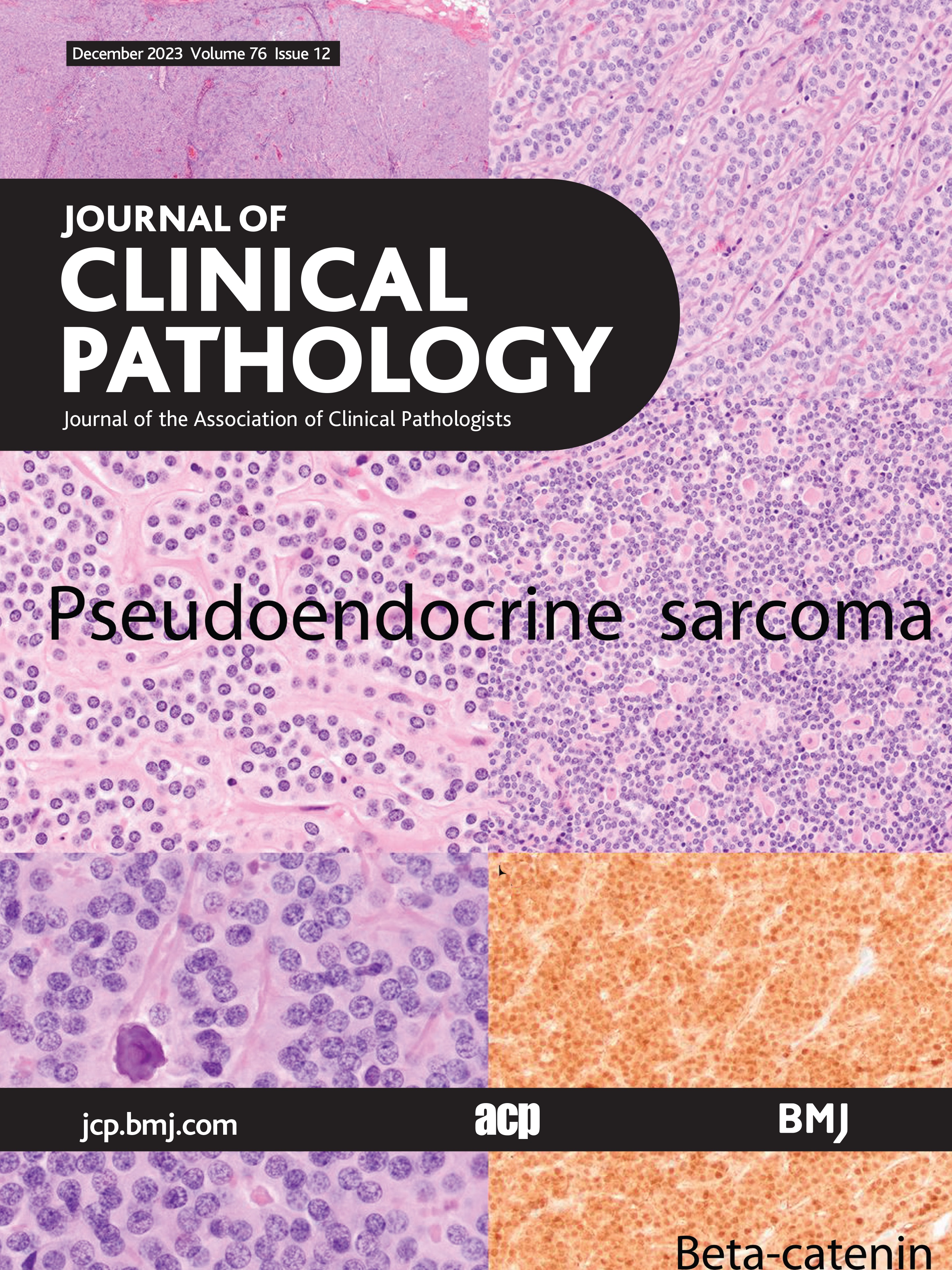 Molecular characterisation of Hb Akron [{beta}52 (D3) Asp->Val] combined with thalassaemia in a Chinese family