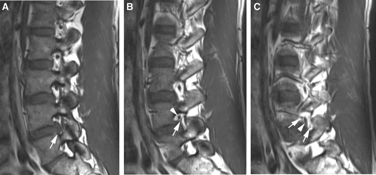 Preferred Insertion Site for Transforaminal Epidural Steroid Injections: Safe Triangle or Kambin’s Triangle?