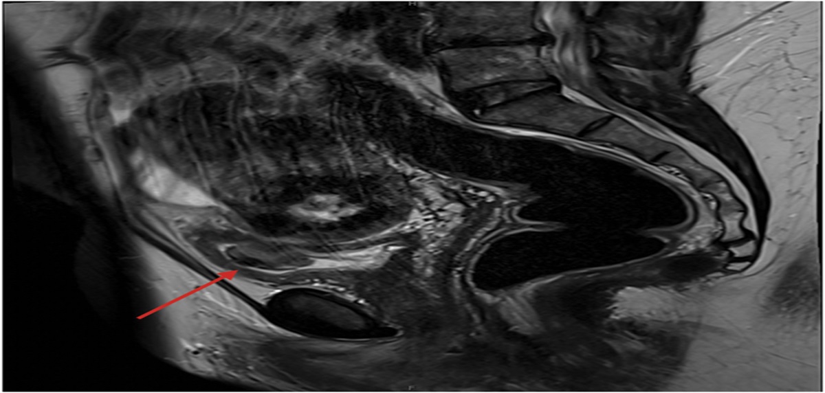 Leiomyoma Fistulization After Uterine Artery Embolization