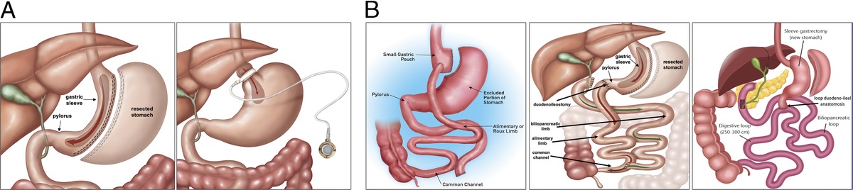 Common postbariatric surgery emergencies for the acute care surgeon: What you need to know