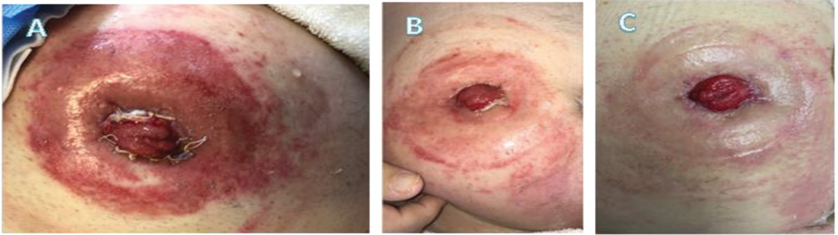 Peristomal Moisture-Associated Skin Damage Treatment: Use of Cyanoacrylate Liquid Skin Protectant: A Case Series