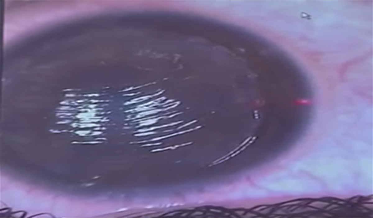 Late approach for LASIK flap striae