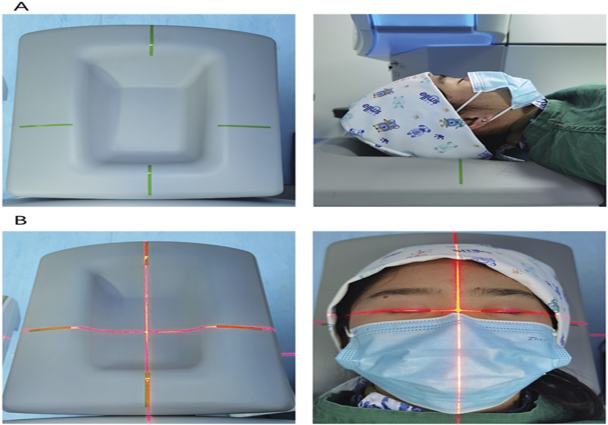 Comparison of myopic astigmatic correction after cross-assisted SMILE, FS-LASIK, and transPRK